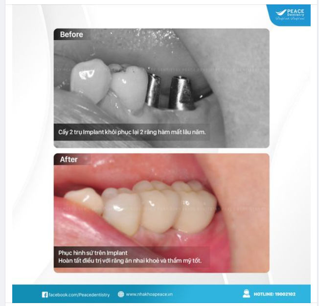 NẾU BIẾT TRỒNG RĂNG IMPLANT TỐT VÀ ĐƠN GIẢN THẾ NÀY THÌ CHỊ ĐÃ LÀM TỪ LÂU!