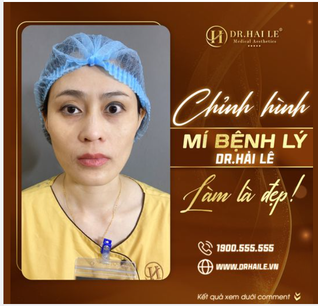 Chỉnh hình mí bệnh lý Dr Hải Lê- Làm là đẹp