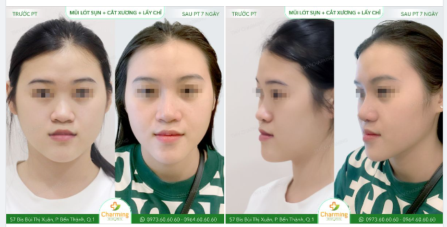Nàng khách của Charming trước đây từng thực hiện nâng mũi chỉ nên hiệu quả nâng mũi không được lâu dài như nàng tưởng.