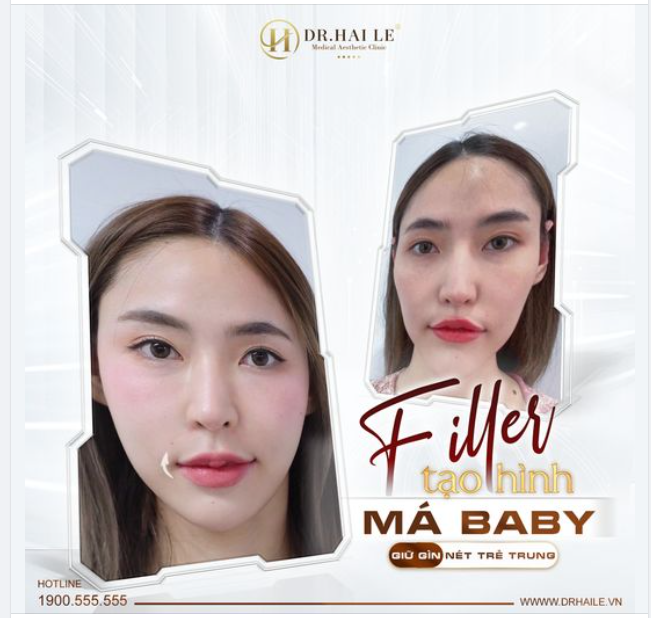 Filler tạo hình má baby, giữ gìn nét trẻ trung