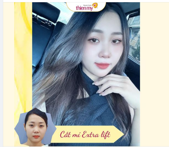 Những lưu ý khi cắt mí: