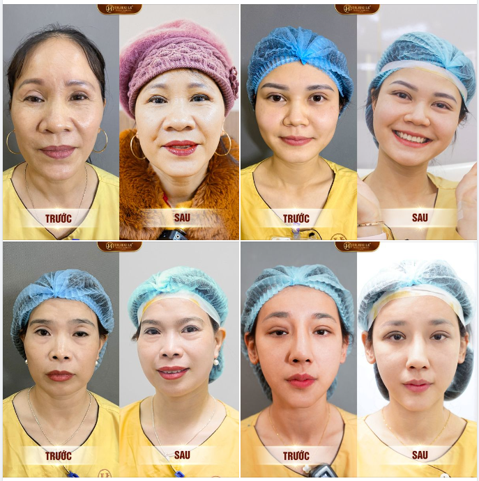 HỆ LỤY TỪ BIẾN CHỨNG MÍ HỎNG - KINH NGHIỆM PTTM MẮT AN TOÀN - ĐÂU LÀ THỜI ĐIỂM VÀNG SỬA MÍ LỖI HỎNG HIỆU QUẢ