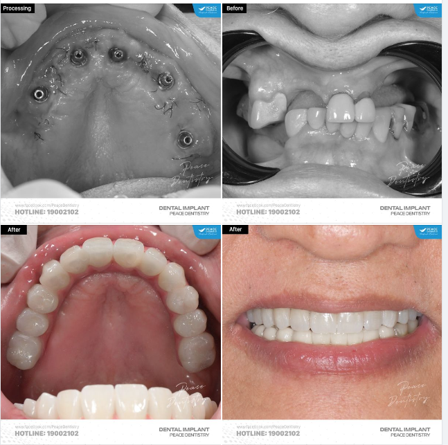 ALL-ON-5 IMPLANT IMPLANT TOÀN HÀM | PHỤC HÌNH TỨC THÌ