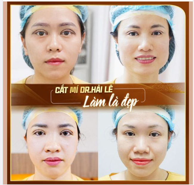 Cắt mí Dr Hải Lê làm là đẹp