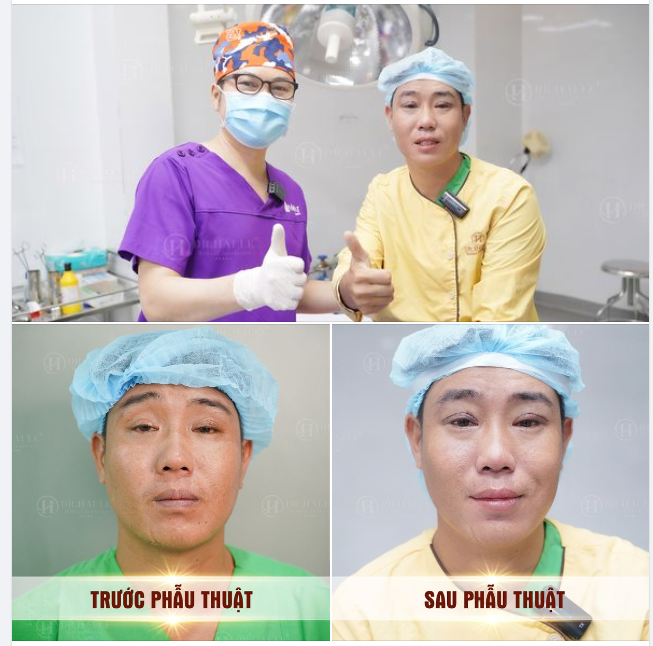 Bệnh lý sụp mí bẩm sinh có lẽ đã không còn xa lạ với nhiều người.