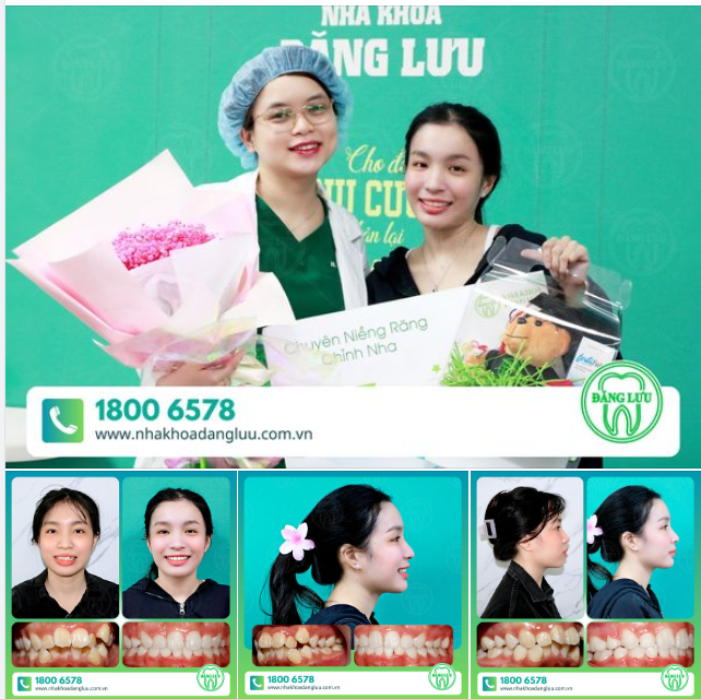 RĂNG XINH RỒI, THÁO NIỀNG THÔI!!!