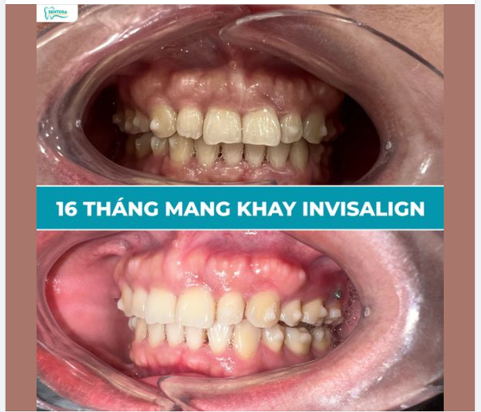 Khớp cắn sâu có Niềng răng Invisalign được không?