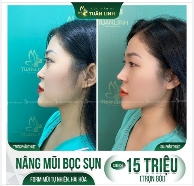 Nâng mũi Sline sụn tai - 15 triệu trọn gói