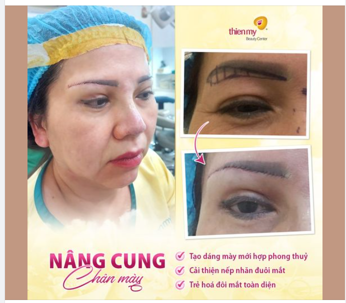 Úp 1 chiếc ảnh xịn xò khách hàng thực hiện nâng cung chân mày tại Thiện Mỹ đây ạ!