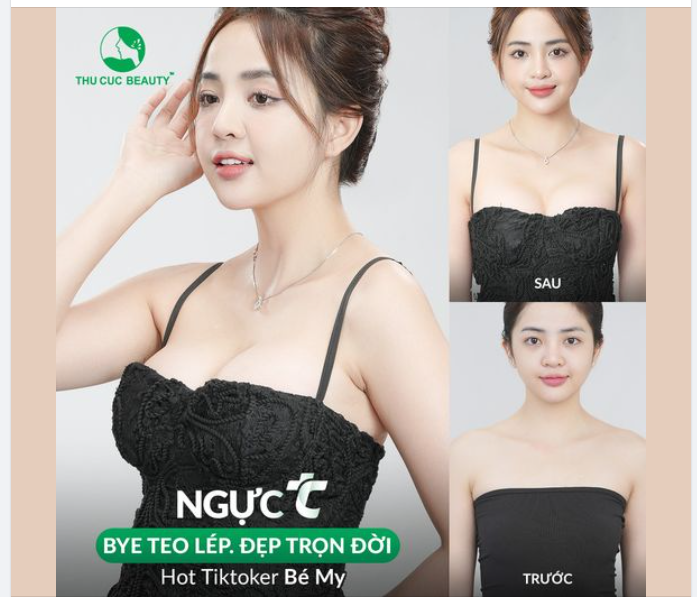 Sở hữu vòng 1 quyến rũ. Khuôn ngực tròn đầy. Thoải mái vận động. Tự tin vóc dáng mới