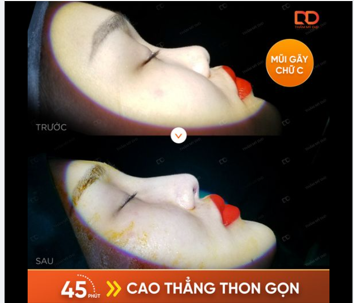 HÌNH ẢNH THỰC TẾ Kết quả sau nâng mũi Perfect Dform VIP vừa thực hiện.