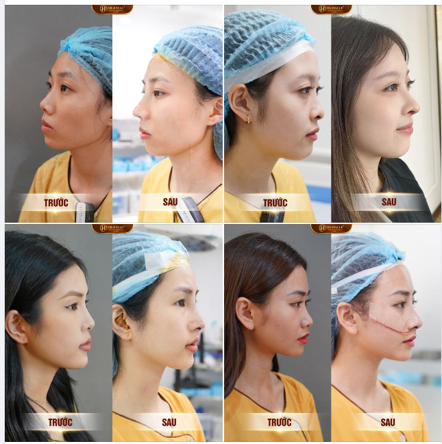 TỔNG HỢP KHÁCH HÀNG NÂNG MŨI THÀNH CÔNG TẠI DR.HẢI LÊ ️