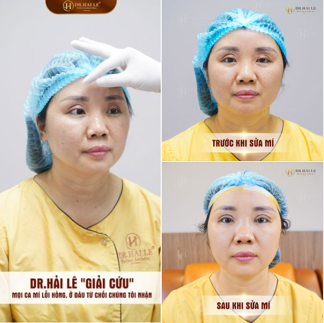 Sửa mí thời điểm vàng chính là giai đoạn can thiệp chỉnh hình mí lỗi hỏng để đôi mắt đạt kết quả tối ưu nhất.