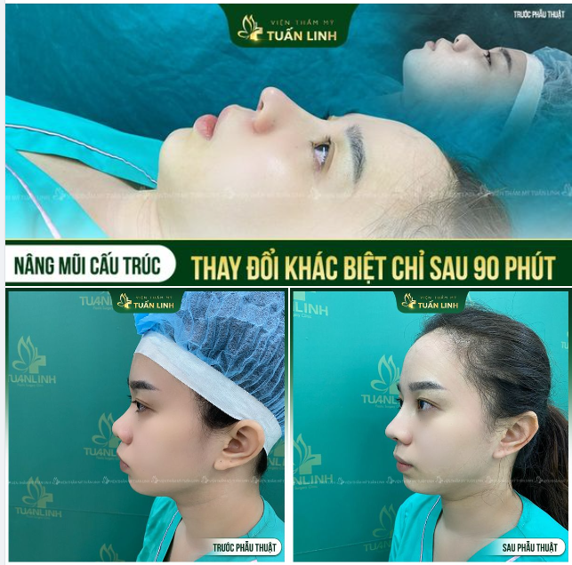 Cách để trở lên xinh đẹp hơn. Nâng mũi tại Tuấn Linh!!