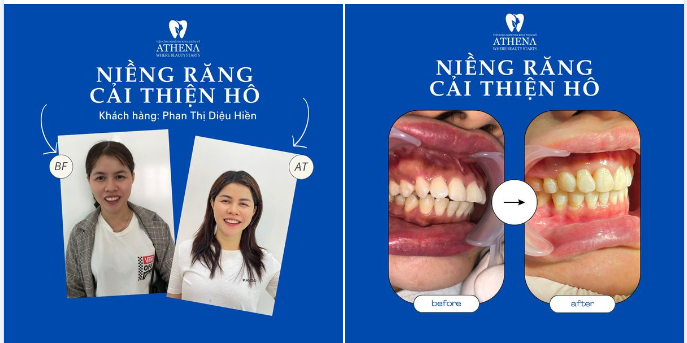 RĂNG BỊ HÔ - NIỀNG RĂNG CÓ HẾT KHÔNG?