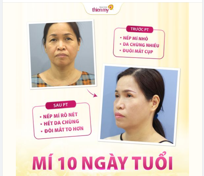 CẮT MÍ AN TOÀN – MẮT ĐẸP TOÀN DIỆN