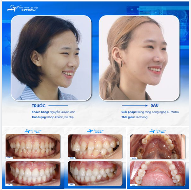 CHẤM DỨT CHUỖI NGÀY SỐNG KHÉP KÍN VÌ “RĂNG XẤU”, KHÁCH HÀNG THỎA SỨC KHOE CÁ TÍNH!