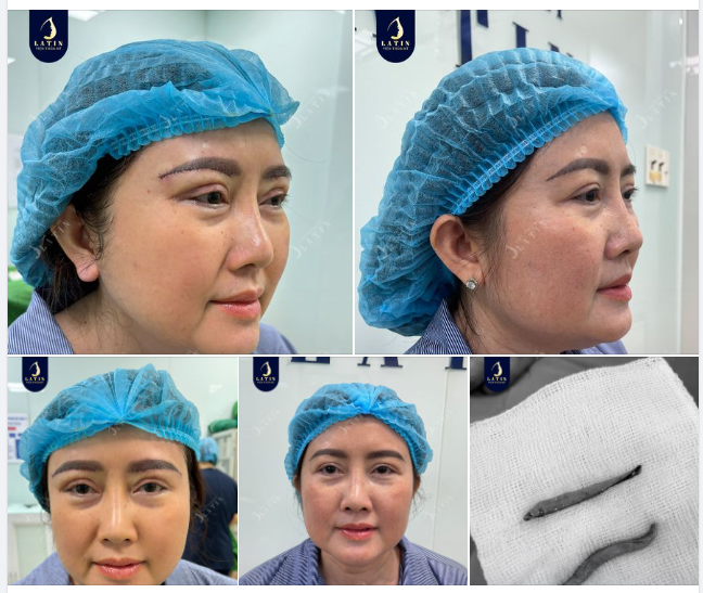 Tự ti vì mắt sụp mí, mỡ thừa mí mắt nhiều nhưng không muốn cắt mí