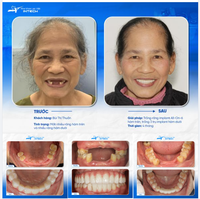 "TÔI CHỈ MONG MUỐN: TRỒNG RĂNG 1 LẦN CHẮC KHỎE MÃI MÃI"