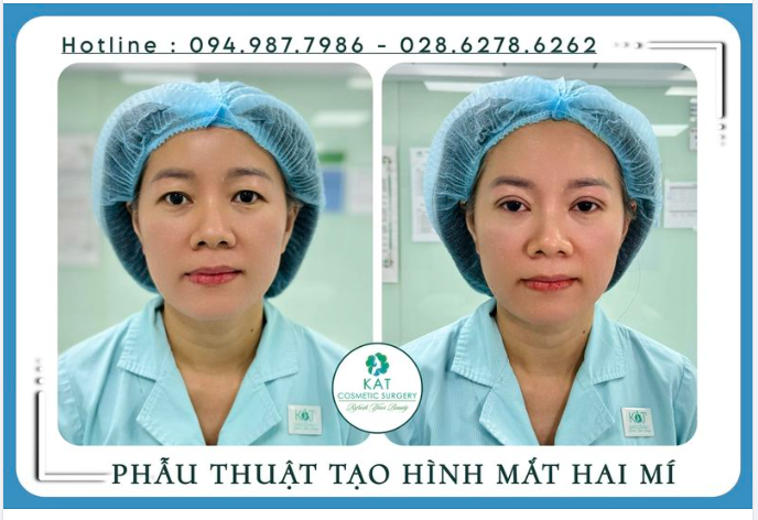 Trên 30 tuổi có nhấn mí được không/? - Câu hỏi được rất nhiều chị em thắc mắc