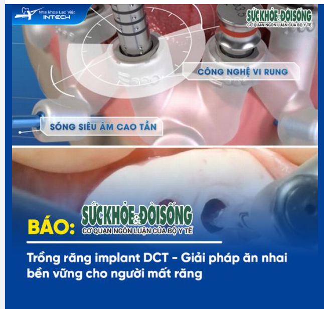 TRỒNG RĂNG IMPLANT DCT - GIẢI PHÁP ĂN NHAI BỀN VỮNG CHO NGƯỜI MẤT RĂNG