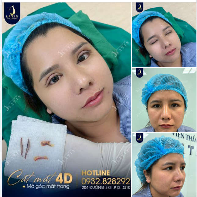 Nỗi lo của chị gái đã từng cắt mí trước đó nhưng chưa ưng ý:
