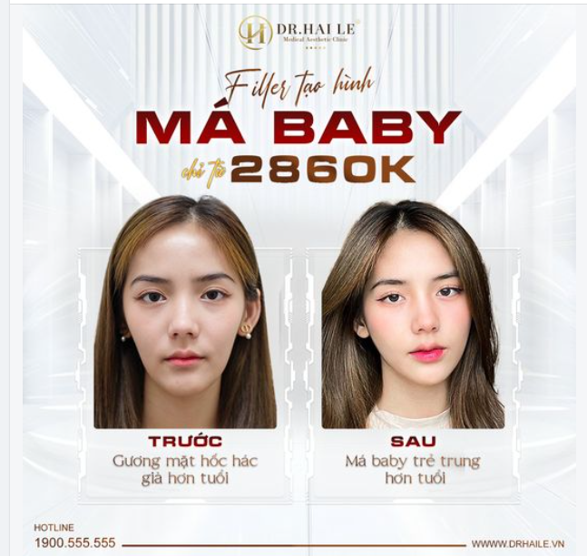 Filler tạo hình má baby  - Chỉ từ 2680k
