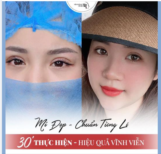 CHỈ 30 PHÚT SỞ HỮU MẮT 2 MÍ ĐẸP VĨNH VIỄN !