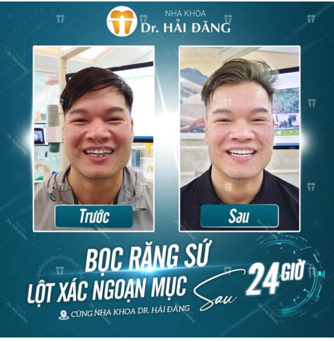 BỌC RĂNG SỨ LỘN XÁC NGOẠN MỤC CHO SOÁI CA