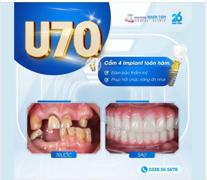 U70 tìm lại nụ cười tại Nhân Tâm Khám phá ngay!