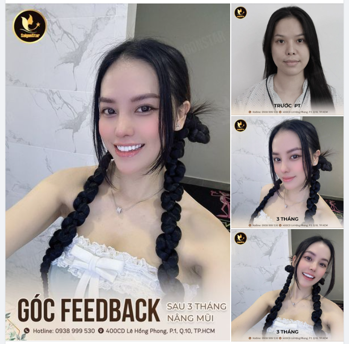 GÓC FEEDBACK SAU 3 THÁNG NÂNG MŨI
