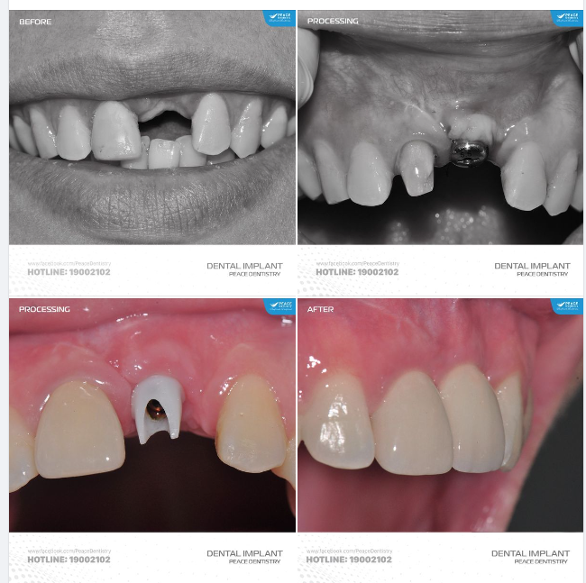 PHỤC HỒI TRỌN VẸN CHỨC NĂNG ĂN NHAI & THẨM MỸ VỚI CÁC TRƯỜNG HỢP MẤT RĂNG, TIÊU XƯƠNG, TỤT NƯỚU...