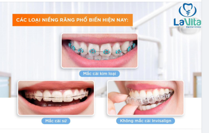 TÌM HIỂU VỀ CÁC LOẠI NIỀNG RĂNG PHỔ BIẾN NHẤT HIỆN NAY