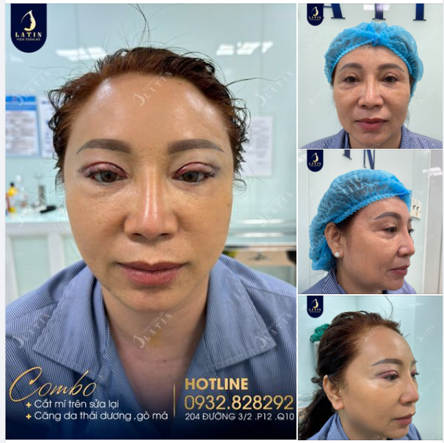 Combo trẻ hóa cho chị gái. Mí 4D sửa lại, Căng da thái dương, gò má