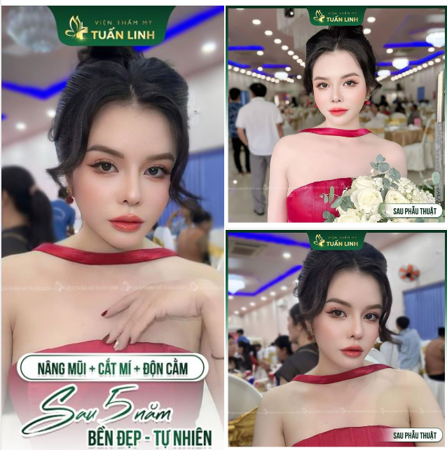 MŨI, CẰM, MÍ SAU 5 NĂM SẼ NHƯ THẾ NÀO???