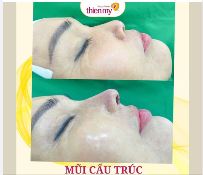 Nâng mũi cấu trúc-cải thiện mũi nhiều khuyết điểm