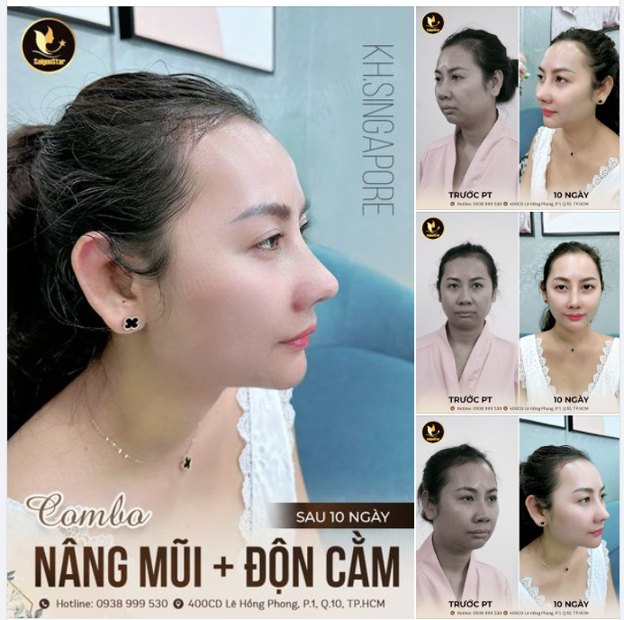KẾT QUẢ NÂNG MŨI + ĐỘN CẰM SAU 10 NGÀY