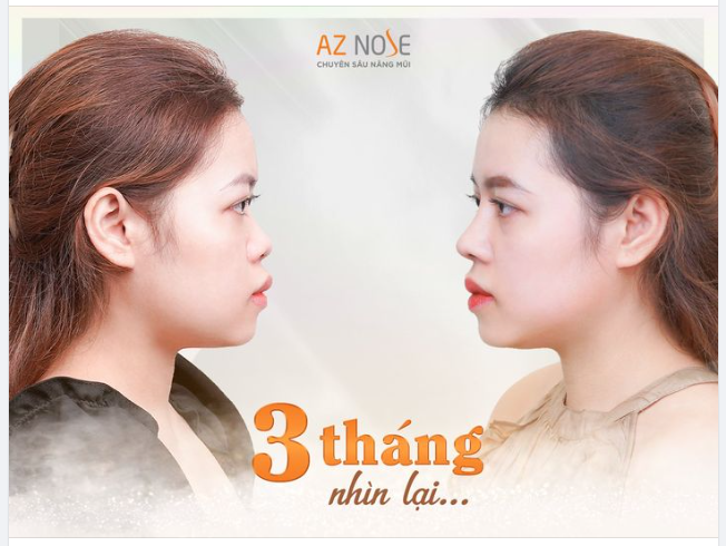 "Dáng mũi phù hợp" là yếu tố quan trọng giúp đường nét trên gương mặt hài hoà hơn.