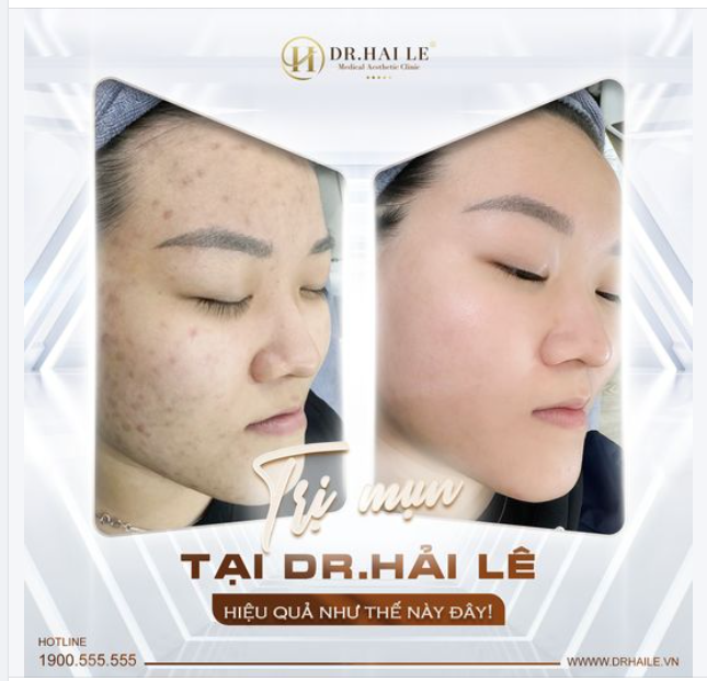 Trị mụn tại Dr hải Lê hiệu quả như thế này đây