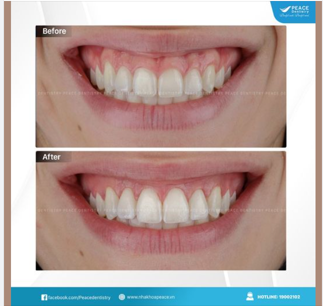 HAI KẾ HOẠCH ĐIỀU TRỊ PHỔ BIẾN CHO CƯỜI HỞ LỢI: