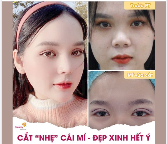 TẠO HÌNH MẮT 2 MÍ VỪA ĐẸP VỪA AN TOÀN