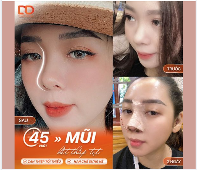 Chia tay mũi thấp, thô, 45 phút có ngay dáng mũi xinh, tự tin lên hình.