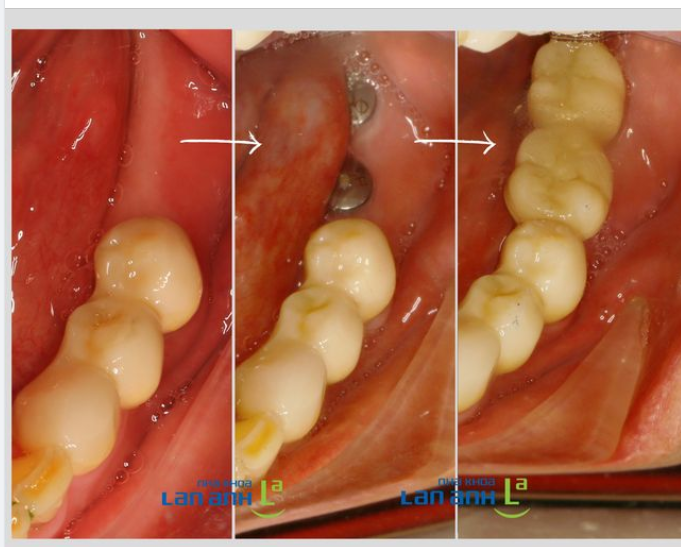 Bạn có thấy vị trí đặt Implant bị "chệch" so với nướu răng và suy nghĩ ban đầu của bạn không?