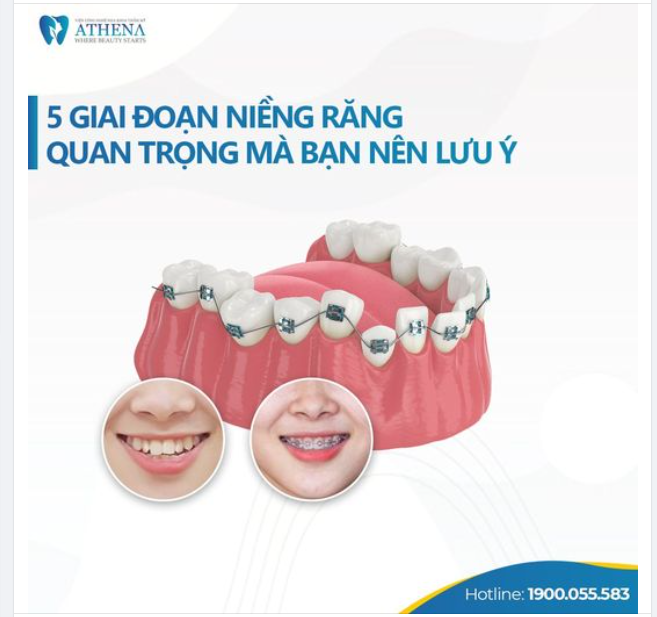 5 GIAI ĐOẠN NIỀNG RĂNG QUAN TRỌNG MÀ BẠN NÊN LƯU Ý