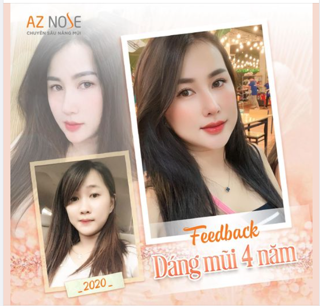 Tự tin và thần thái hơn hẳn. Nhanh tay xin vía “lột xác” hoàn toàn sau nâng mũi của chị Th.T. đến từ Long Khánh nào!!