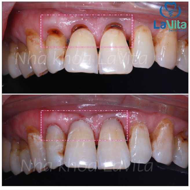 MÒN CỔ RĂNG: NGUYÊN NHÂN VÀ CÁCH KHẮC PHỤC