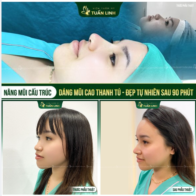 Dáng mũi cực phẩm sau 90 phút nâng tại Tuấn Linh!