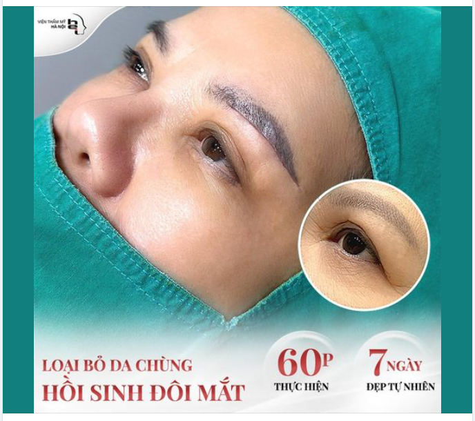CÓ PHẢI DA CHÙNG, VẾT CHÂN CHIM VÙNG MẮT LÀ NGUYÊN NHÂN KHIẾN KHUÔN MẶT GIÀ ĐI CẢ CHỤC TUỔI??