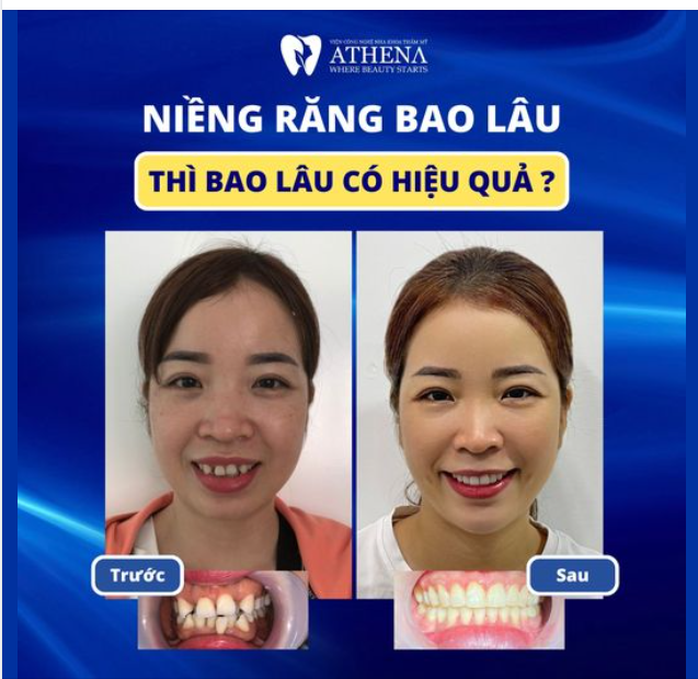 NIỀNG RĂNG BAO LÂU THÌ CÓ KẾT QUẢ?