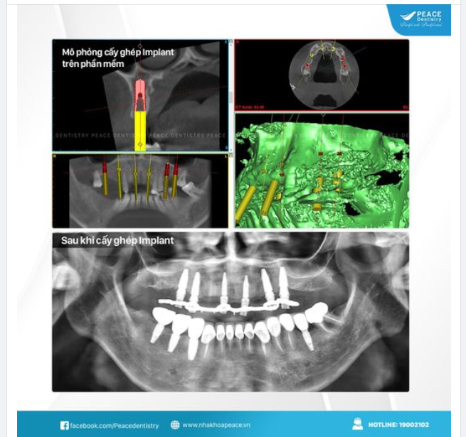 MÔ PHỎNG VỊ TRÍ, KÍCH THƯỚC TƯƠNG QUAN CỦA IMPLANT TRÊN PHẦN MỀM